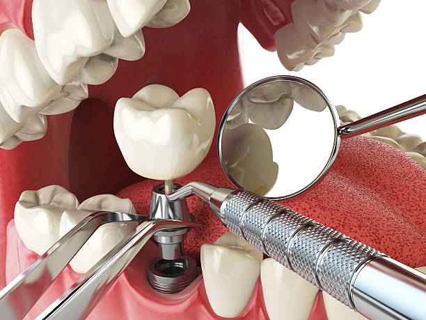 Best Emergency Tooth Extraction in Iron River, MI